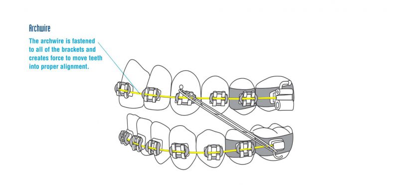 Archwire