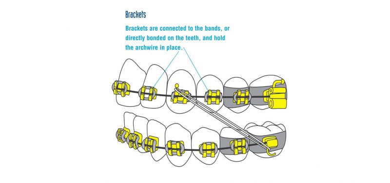 Brackets