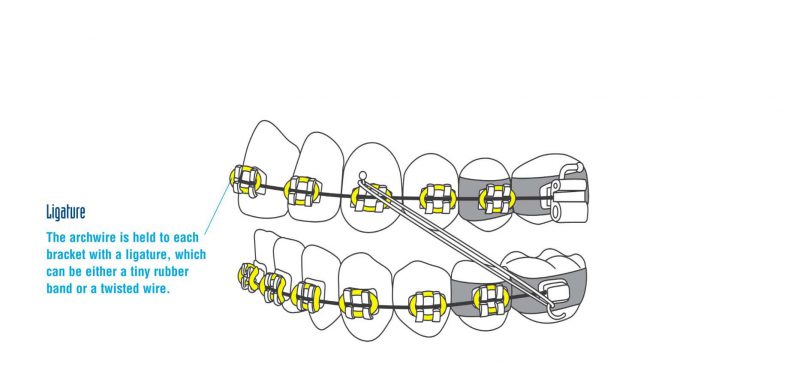 Ligature