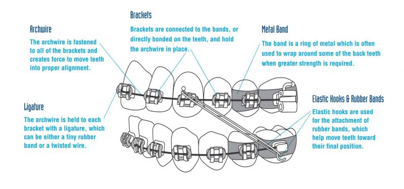 Parts of Braces