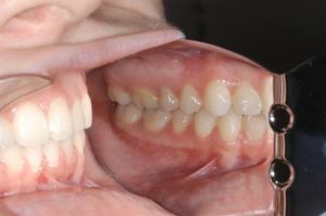 17.5 yr retention smile