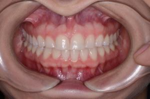 05.10yr retention frontal