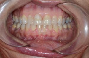 03.14 yr retention frontal