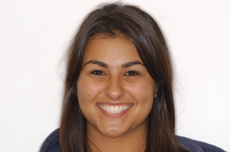 18.5 yr retention smile