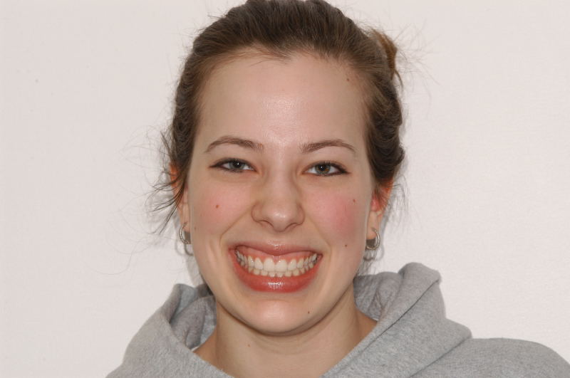 19.5 yr retention smile