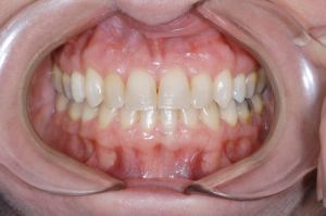 07.10 yr retention frontal