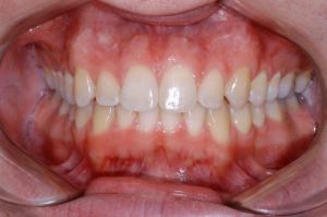 08.9 yr retention frontal