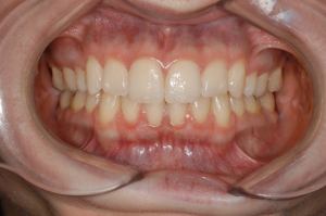 09.8 yr retention frontal